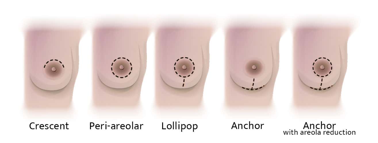Dr. Raskin breast reduction incision options