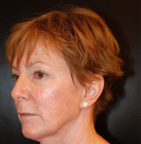 Facelift