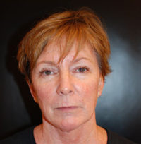 Facelift