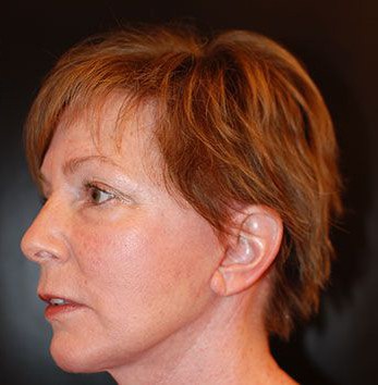 Facelift