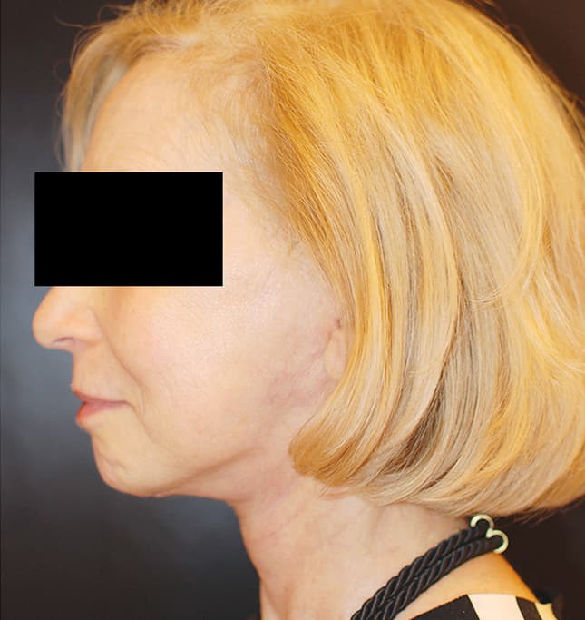 Facelift
