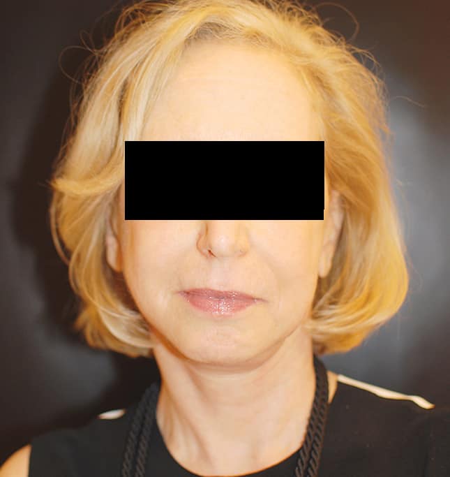 Facelift