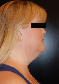Neck Lift