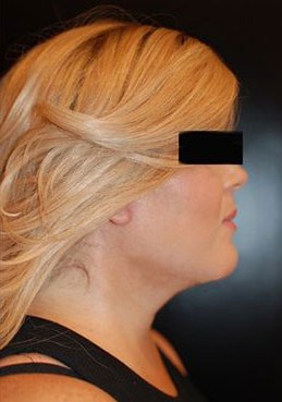 Neck Lift
