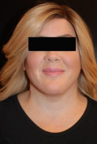 Neck Lift