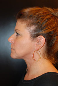 Neck Lift