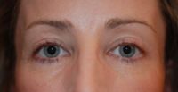 Blepharoplasty