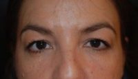 Blepharoplasty