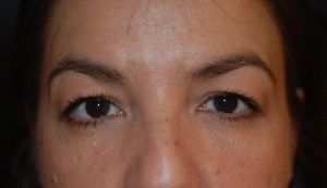 Blepharoplasty