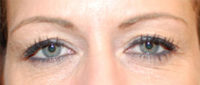 Blepharoplasty