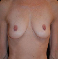 Breast Augmentation