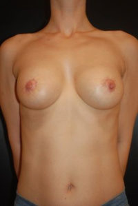 Breast Augmentation