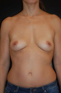 Breast Augmentation