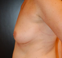 Breast Augmentation