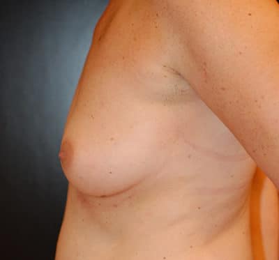 Breast Augmentation