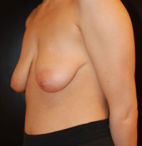 Breast Lift