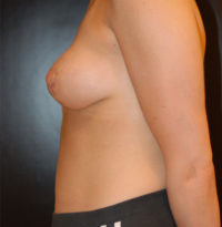 Breast Lift