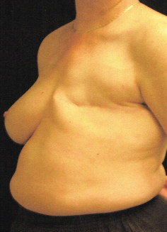 Breast Reconstruction