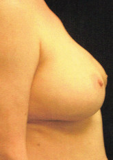 Breast Reconstruction