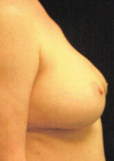 Breast Reconstruction
