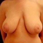 Breast Reduction