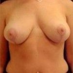 Breast Reduction
