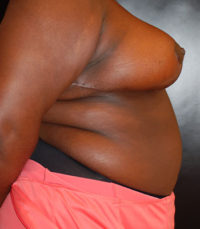 Breast Reduction