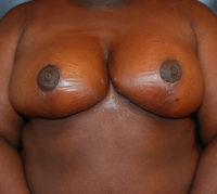 Breast Reduction