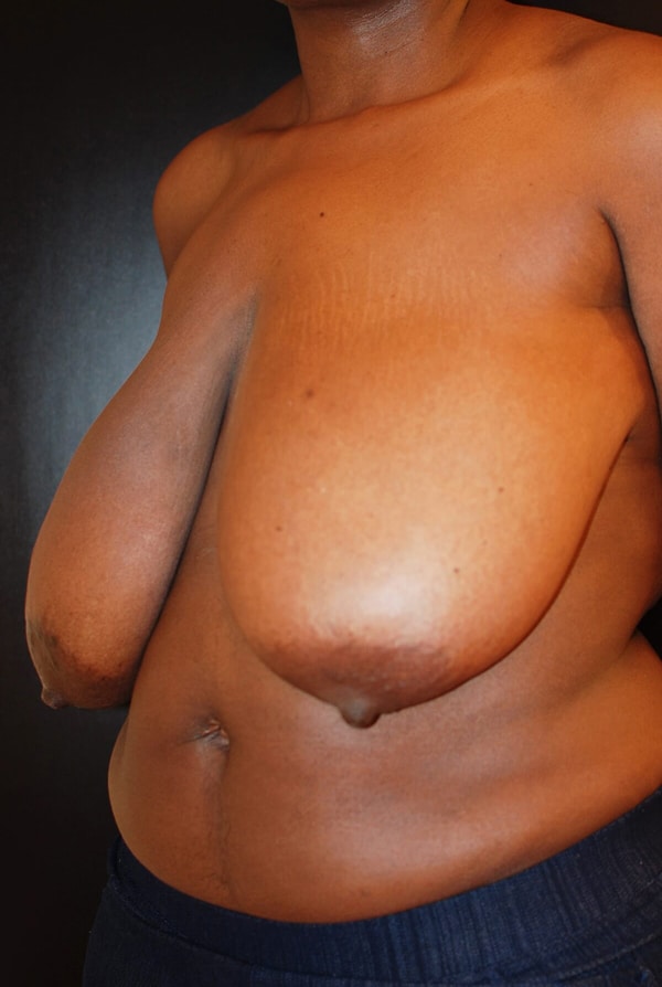 Breast Reduction