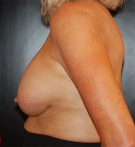 Breast Revision / Capsular Contracture