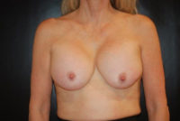 Breast Revision / Capsular Contracture