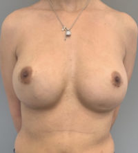 Breast Revision / Capsular Contracture