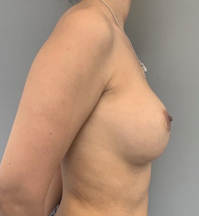 Breast Revision / Capsular Contracture