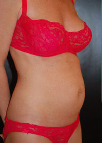 Tummy Tuck (Abdominoplasty)