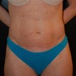 Smartlipo