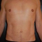 Smartlipo