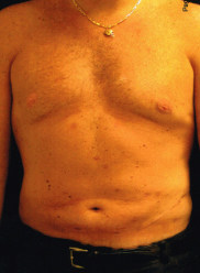 Male Breast Reduction (Gynecomastia) Case 641 After Photo Male Breast Reduction (Gynecomastia)