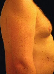 Male Breast Reduction (Gynecomastia)
