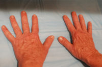 Injections