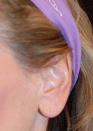 Earlobe Repair/Reduction