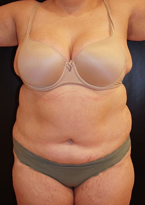 Liposuction Before & After