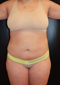 Liposuction