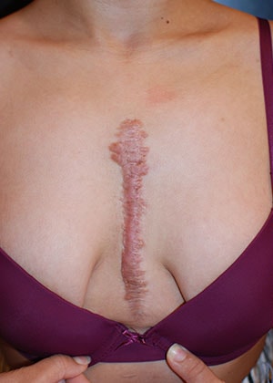 Scar Revision