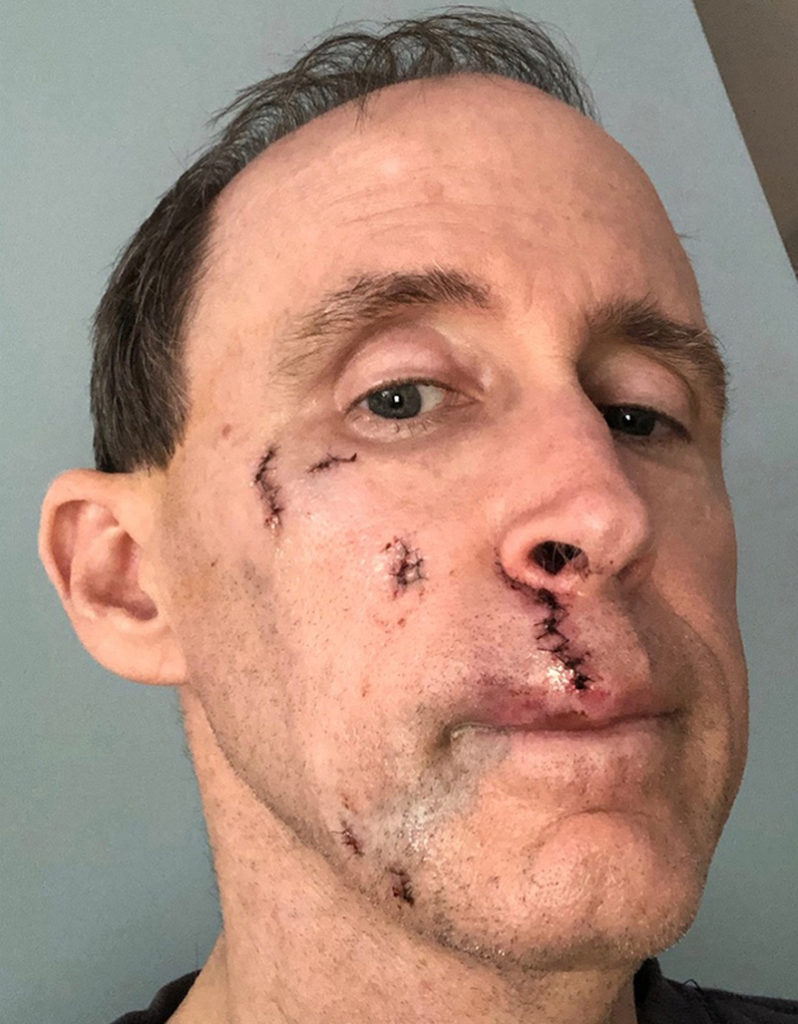 Scar Revision