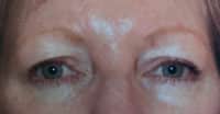 Blepharoplasty