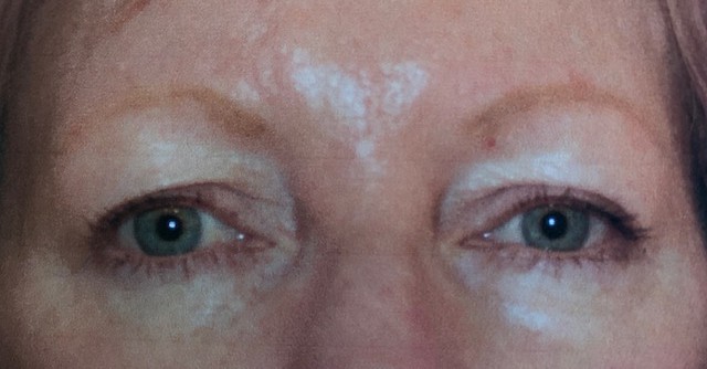 Blepharoplasty