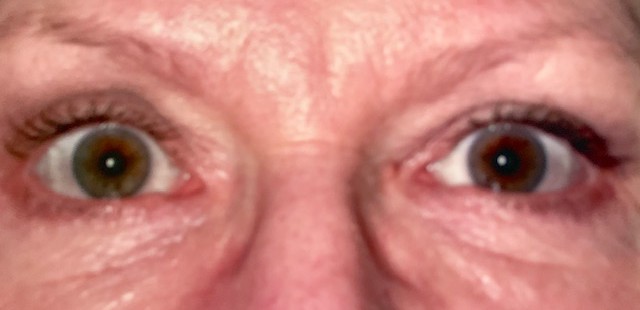 Blepharoplasty