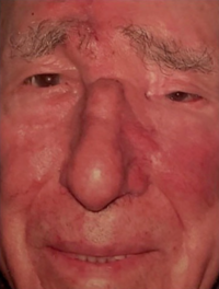 Mohs Surgery Reconstruction