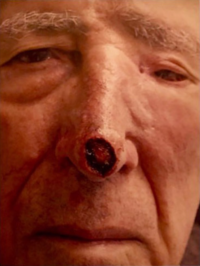 Mohs Surgery Reconstruction