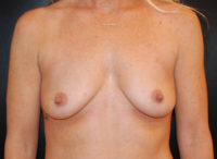 Breast Augmentation with Fat Grafting